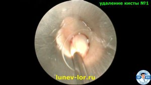 Микрогайморотомия. Удаление кист из верхнечелюстной пазухи.