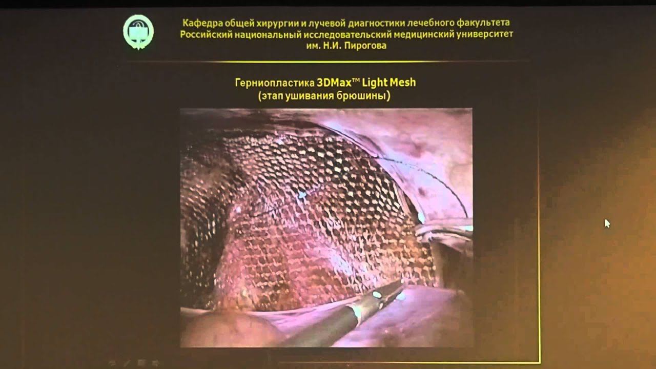 4   07   С В  Харитонов   Герниопластика 3DMax Light Mech Особенности и Результаты
