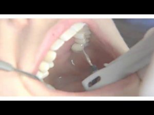 Vector PARO. Парадонтологический аппарат Обзор