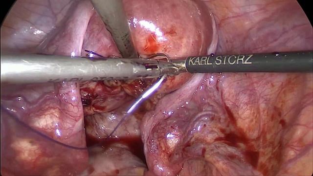 Лапароскопическая миомэктомия