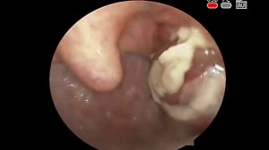 Острый бактериальный рецидивирующий #тонзиллит #Ангина, #кандидоз глотки acute #tonsillitis