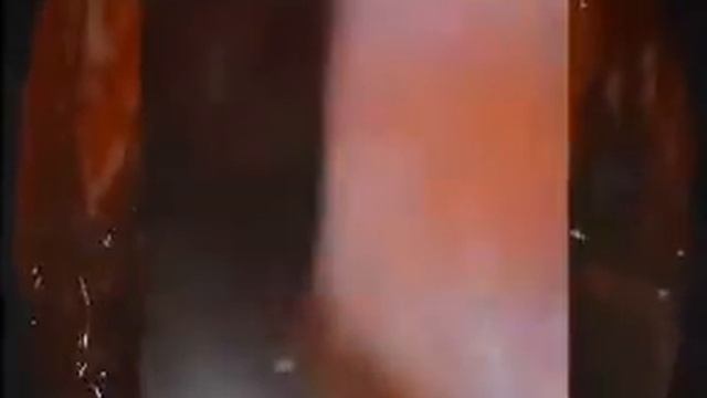 гайморотомия