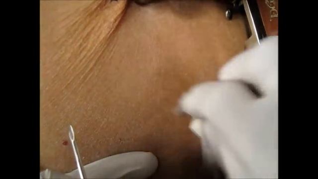 How To Give Goserelin Injection By Subcutaneous Mode?