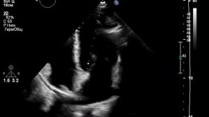 Незаращение овального окна. Как оно выглядит в 45 лет и к чему это приводит?