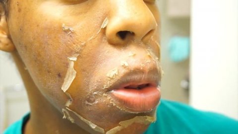 I GOT A CHEMICAL PEEL ! Full Process + Results | Remove Dark Marks, Enlarged Pores & Wrinkles