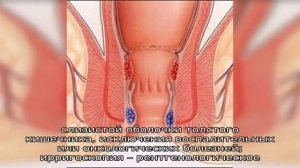 Симптомы и лечение спазма сфинктера прямой кишки