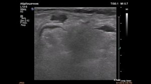 Ущемлённая бедренная грыжа с некрозом петли тонкой кишки