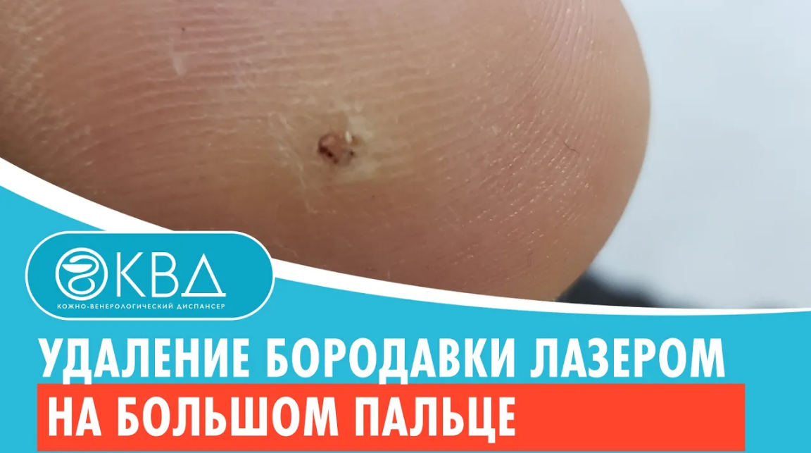 ✅ Удаление бородавки лазером на большом пальце. Клинический случай №515