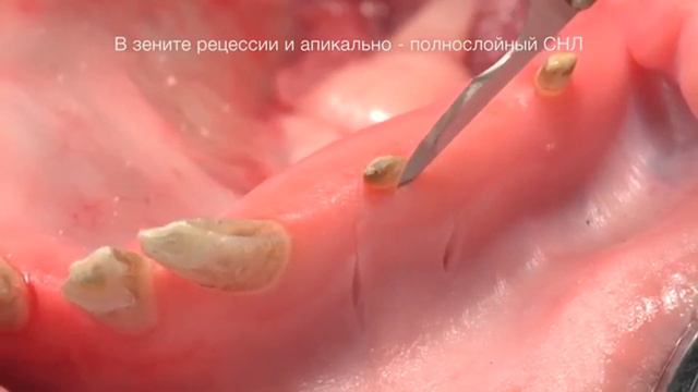 Лечение рецессии десны Часть 21. Ростов-на-Дону 2020 год смотреть онлайн