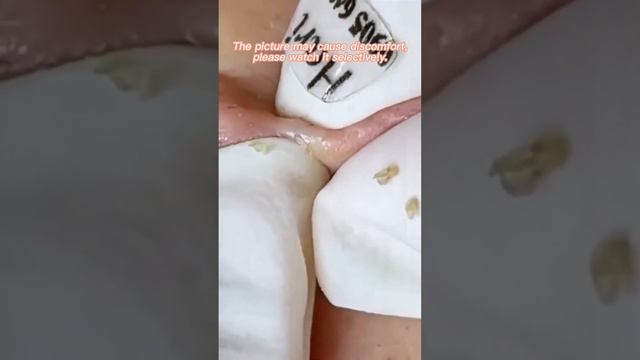 Акне. Черные точки. Вросшие волосы и прыщи. Ушная пробка и сера! смотреть онлайн