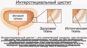 Все об интерстициальном цистите: почему появляется и как лечить