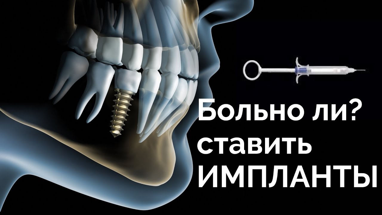 Больно ли ставить имплант. Анестезия. Ход процедуры.