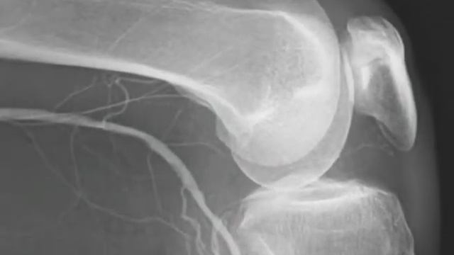 Артроз. Еламед. смотреть онлайн