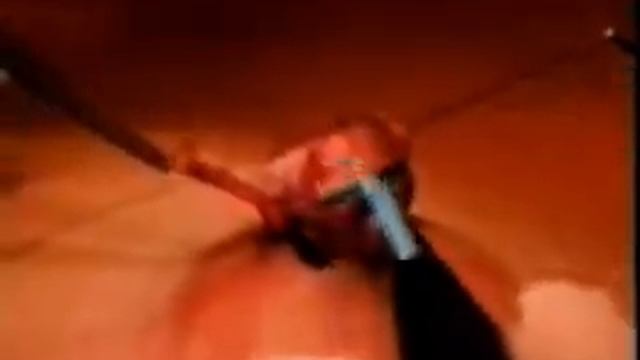 ПЛАСТИКА СОСКА смотреть онлайн