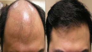 Сильнейшая маска от выпадения волос и облысения. Эффект не заставил себя ждать, делюсь рецептом