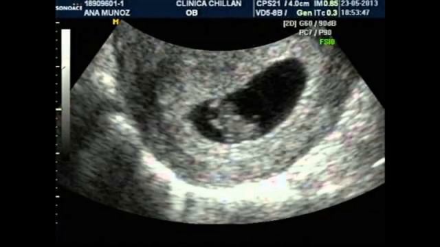 ECOGRAFÍA 7 SEMANAS DE GESTACIÓN EMBRIÓN DE 7 SEMANAS EMBARAZO DE 7 SEMANAS FETOMETRÍA EMBRIONARIA смотреть онлайн