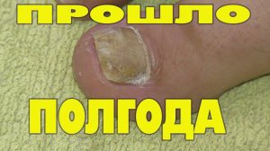 Грибок ногтя на ноге Отзывы для вас