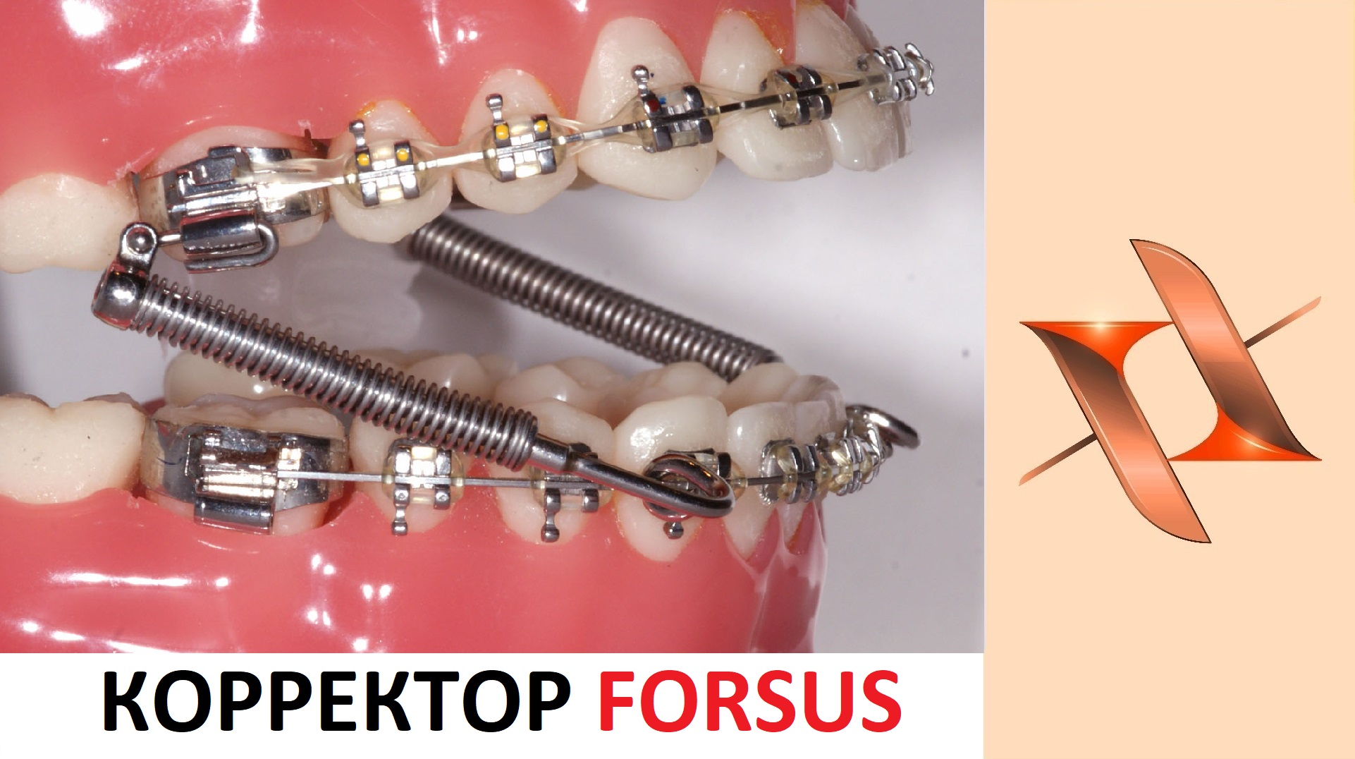 Корректор Forsus. Ортодонтический аппарат.