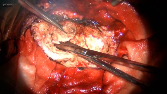 Meningioma #AmerBadran смотреть онлайн