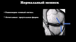 МРТ анатомия менисков коленного сустава