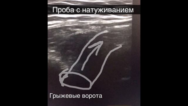 Прямая паховая грыжа при УЗИ. Профессор Гажонова В.Е. смотреть онлайн