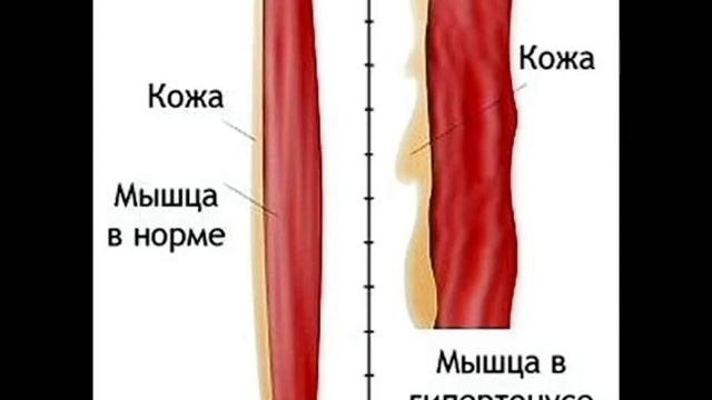 Постизометрическая релаксация мышц лица