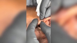 Popping huge blackheads and Giant Pimples - Best Pimple Popping Videos #76