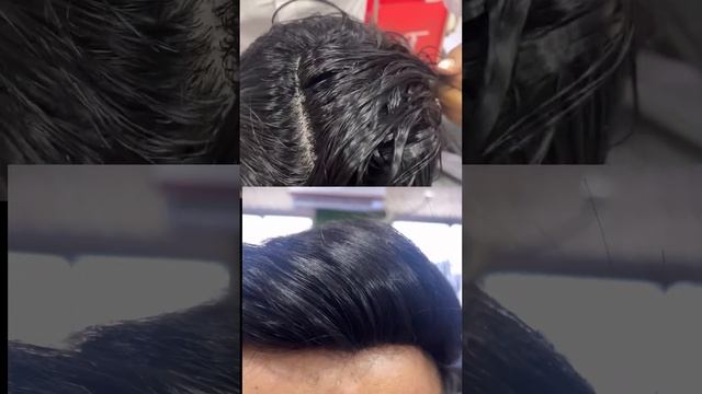 Australian Mirage Front Hair Line # #hairpatch #hairwig #hairreplacement #hairlosssolution #kolkata