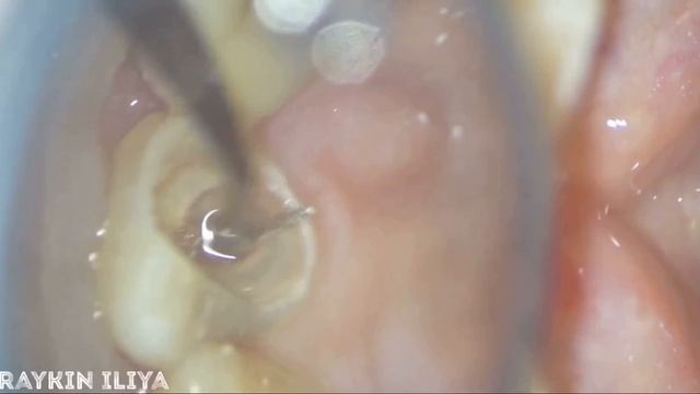 Извлечение инструмента из канала зуба , лечение зубов , пломбировка зубов , отбеливание зубов,винир смотреть онлайн