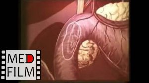 Трансдуоденальная холедохотомия © Transduodenalnym choledochotomy