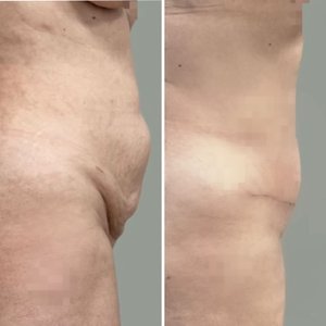 Абдоминопластика: месяц после операции.