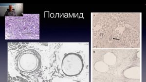 Шовный материал. Часть 2. Распад как свойство шовного материала.