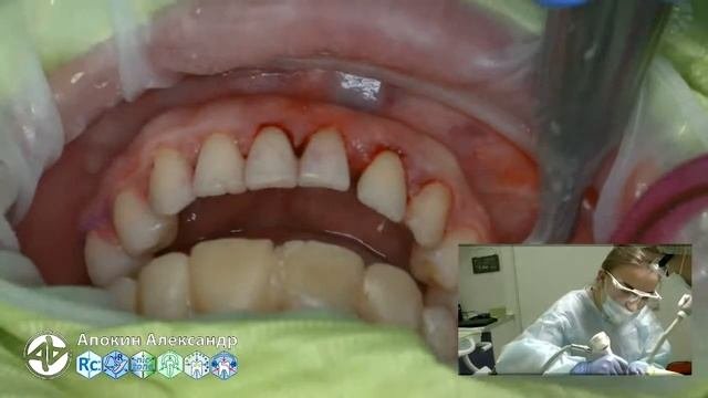 Professional oral hygiene - case 004 Acteon, DTE, Dentsply, Coxo, Floweis, 3M, KerrHawe (livestream