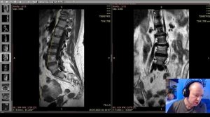 Воспаление позвонков по Модик. Разрушение тела позвонка