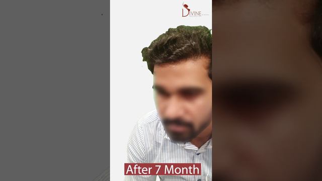 10000 Follicles of Hair Transplant After 7 Months Result