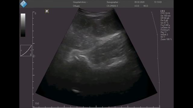 Острая тонкокишечная непроходимость смотреть онлайн