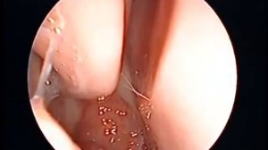 Аденоиды 2   3 степени  Бактериальный синусит справа.mp4