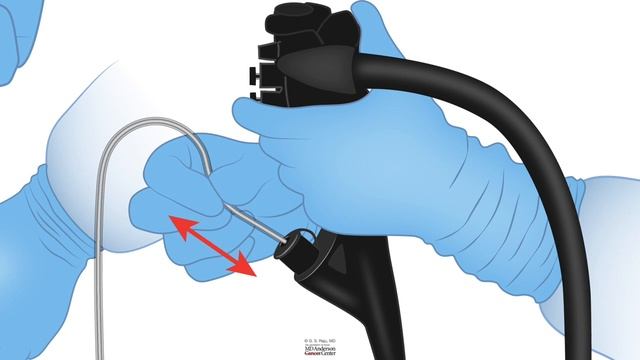 HCC 1475-29-Cyanoacrylate glue for gastric varices смотреть онлайн