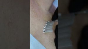 Нити Моно - базовая модификация мезонитей для армирования кожи