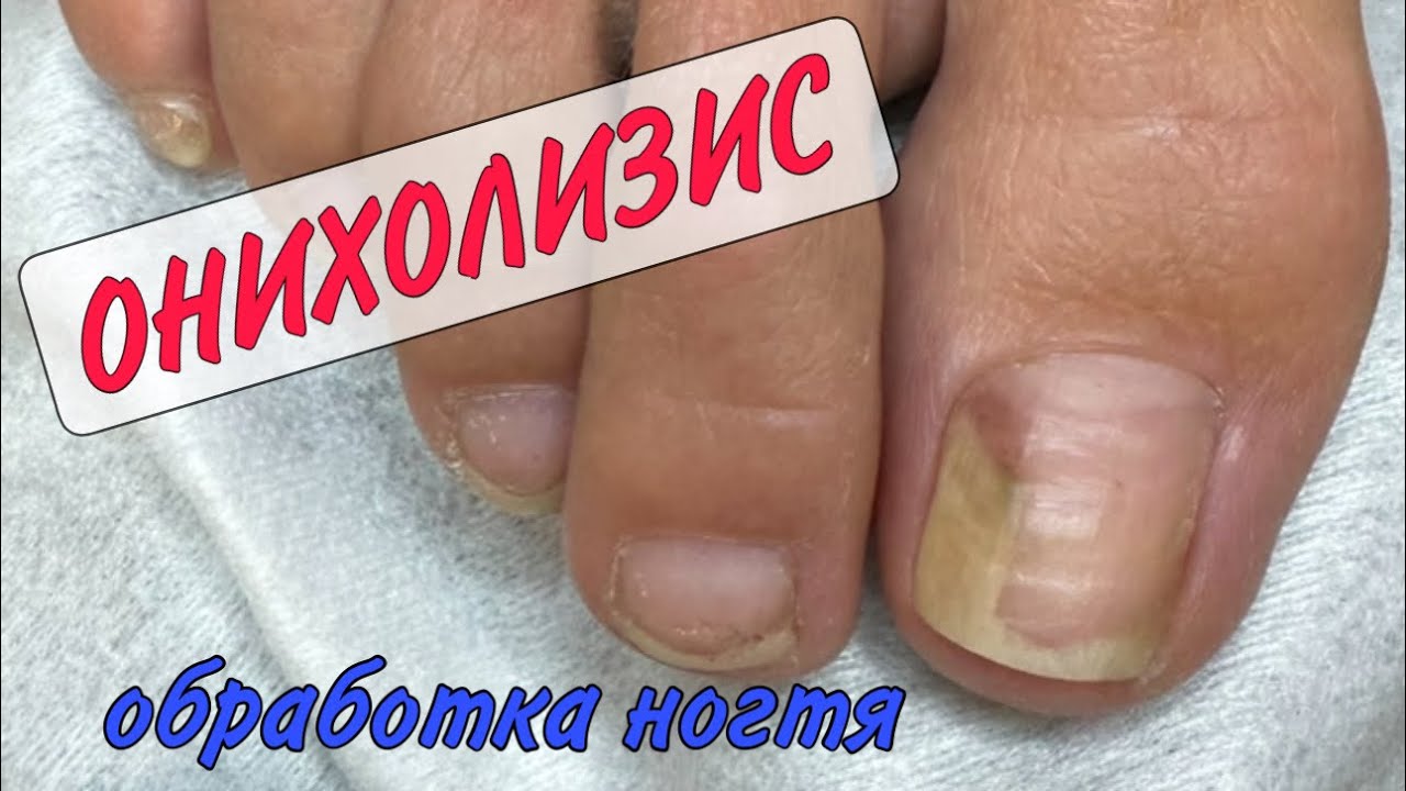 👉🏻 ОНИХОЛИЗИС _ карман под ногтем _ зачистка ногтя