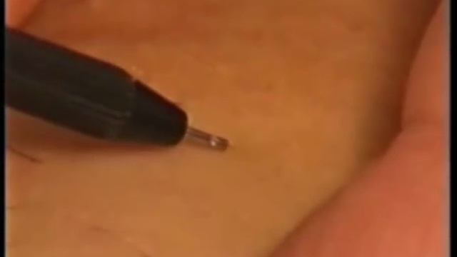 MEK3 Einweisungsvideo 2 Lifting Epilation
