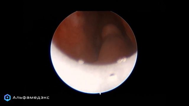 Опыт применения саморасширяющегося стента Аллиум. Зелимхан Омарович Лечиев. смотреть онлайн