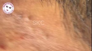 Acne facial removal treatment by Sopheaskincare 29th October 2023
