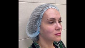 До и сразу после нитевого лифтинга лица