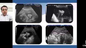 Врожденные пороки развития лица: расщелина верхней губы и неба, клиника, классификация...