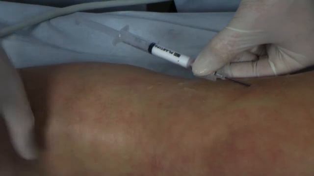 Sclerotherapy for varicose veins - MasterClass - Uldis Maurins