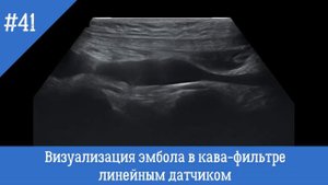 УЗИ сосудов. Визуализация эмбола в кава - фильтре линейным датчиком.