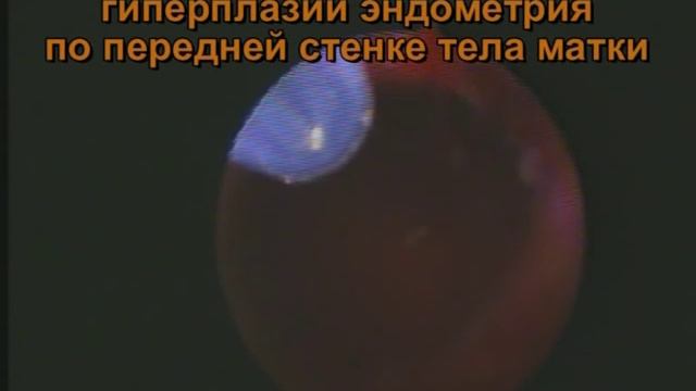 Железистый полип эндометрия. Амбулаторное удаление.
