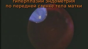 Железистый полип эндометрия. Амбулаторное удаление.