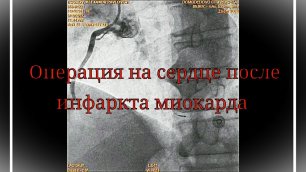 Операция стентирование после инфаркта миокарда / Heart surgery after myocardial infarction